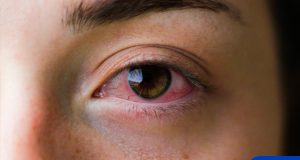 Sore or Irritated Eyes