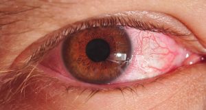 Marco shot of a man's eye suffering from conjunctivitis also known as pink eye.